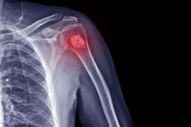 X-ray of shoulder radiograph showing Enchondroma disease.